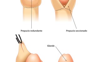 balanitis