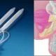 Prótesis de pene: tipos, cirugía de implante y eficacia