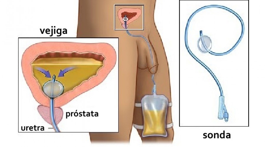 sonda la prostata)