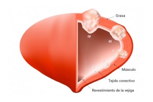 sangre en la orina