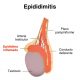 Epididimitis y orquiepididimitis: inflamación y dolor testicular agudo