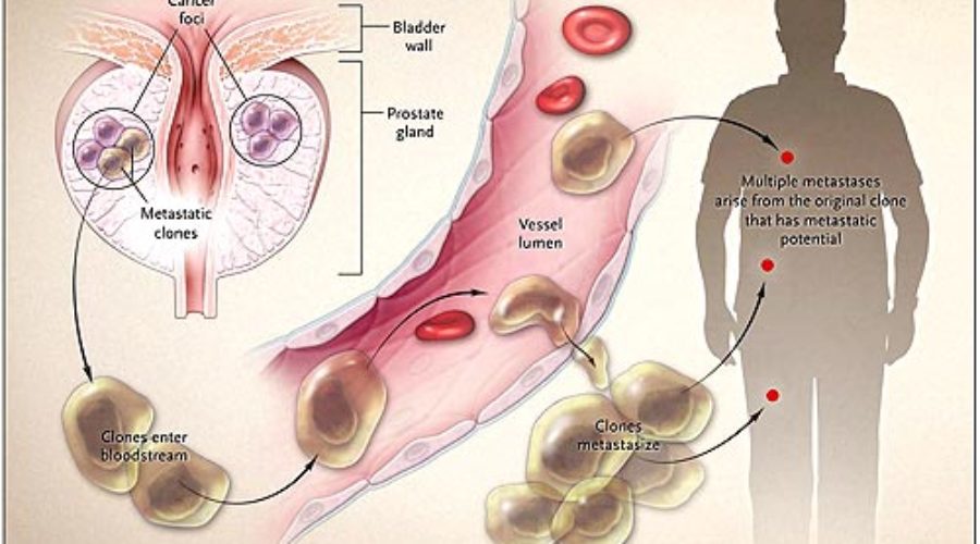 cáncer de próstata metastásico