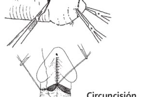 circuncisión