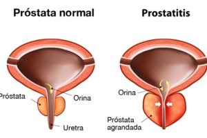prostatitis crónica