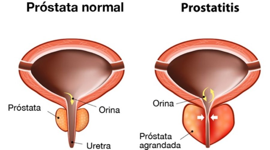 prostatitis abacteriana cronica sintomas