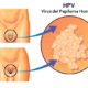 Verrugas genitales y cáncer por el virus del papiloma humano (VPH)