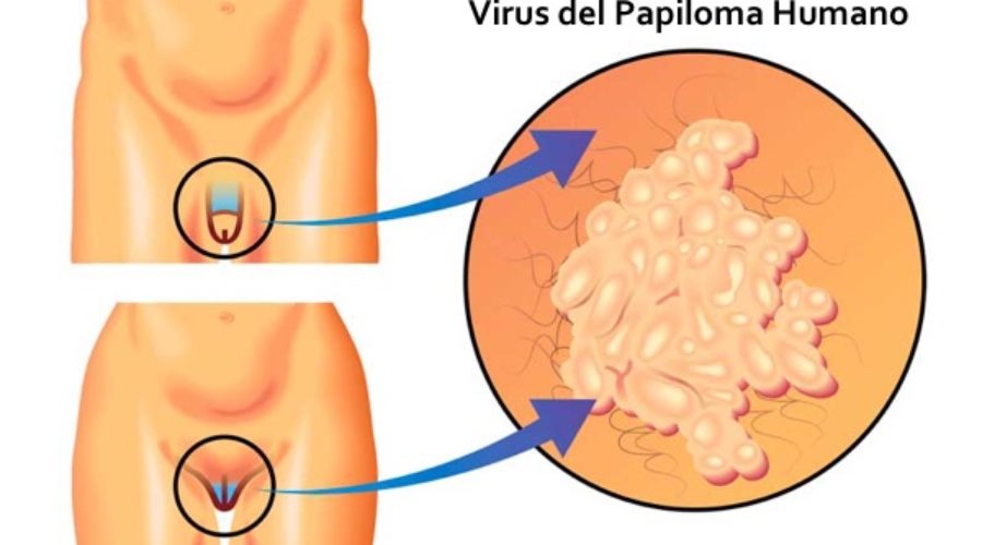 Papiloma virus verruga genital. Vaccin papillomavirus oui ou non