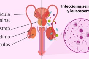 infecciones seminales