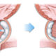 ¿Es posible conservar la eyaculación en la cirugía prostática?