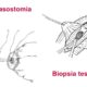 Vaso-vasostomía vs obtención de espermatozoides para FIV